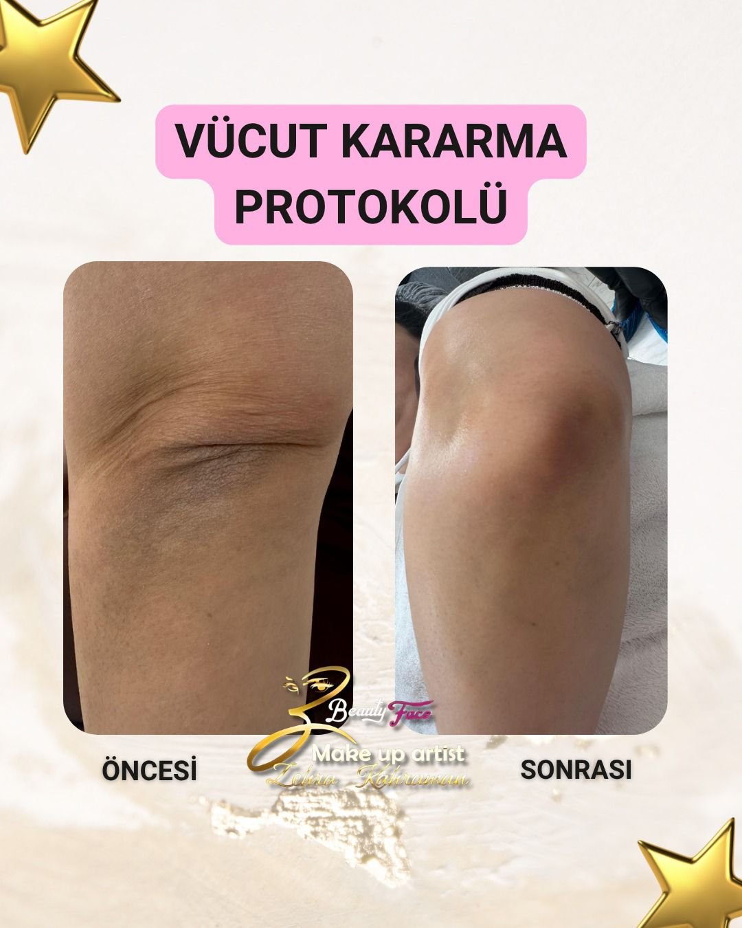 İşlem öncesi